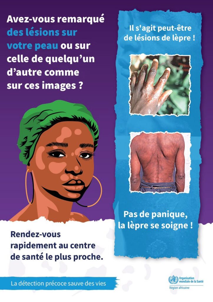 La lèpre : comprendre la maladie pour briser la peur et la stigmatisation